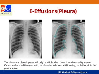 APPROACH TO CHEST X RAYS.pptx