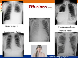 APPROACH TO CHEST X RAYS.pptx