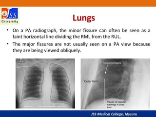 APPROACH TO CHEST X RAYS.pptx