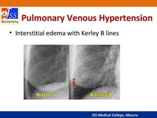 APPROACH TO CHEST X RAYS.pptx