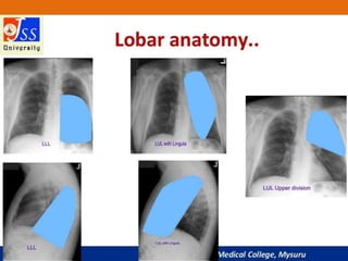 APPROACH TO CHEST X RAYS.pptx