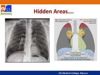 APPROACH TO CHEST X RAYS.pptx