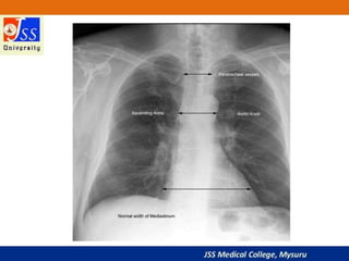 APPROACH TO CHEST X RAYS.pptx