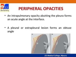 APPROACH TO CHEST X RAYS.pptx