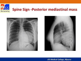 APPROACH TO CHEST X RAYS.pptx
