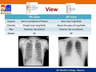 APPROACH TO CHEST X RAYS.pptx
