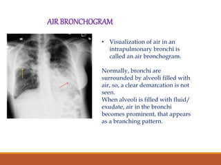APPROACH TO CHEST X RAYS final.pptx
