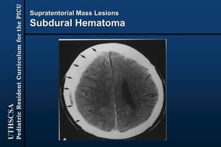 UTHSCSA
PediatricResidentCurriculumforthePICU
Supratentorial Mass Lesions
Subdural Hematoma
 