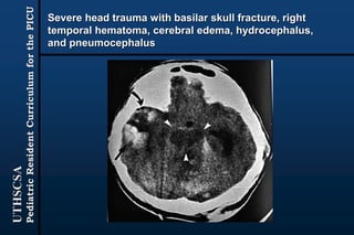 UTHSCSA
PediatricResidentCurriculumforthePICU
Severe head trauma with basilar skull fracture, right
temporal hematoma, cerebral edema, hydrocephalus,
and pneumocephalus
 