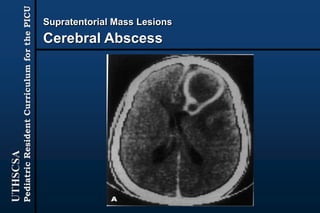 UTHSCSA
PediatricResidentCurriculumforthePICU
Supratentorial Mass Lesions
Cerebral Abscess
 