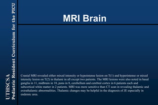 UTHSCSA
PediatricResidentCurriculumforthePICU
MRI Brain
Cranial MRI revealed either mixed intensity or hypointense lesion on T(1) and hyperintense or mixed
intensity lesion on T(2) in thalami in all except two patients. The MRI lesions were also noted in basal
ganglia in 11, midbrain in 18, pons in 8, cerebellum and cerebral cortex in 6 patients each and
subcortical white matter in 2 patients. MRI was more sensitive than CT scan in revealing thalamic and
extrathalamic abnormalities. Thalamic changes may be helpful in the diagnosis of JE especially in
endemic area.
 