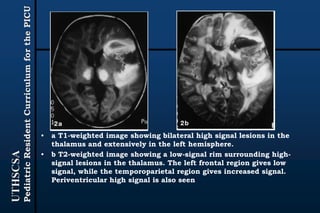 UTHSCSA
PediatricResidentCurriculumforthePICU
• a T1-weighted image showing bilateral high signal lesions in the
thalamus and extensively in the left hemisphere.
• b T2-weighted image showing a low-signal rim surrounding high-
signal lesions in the thalamus. The left frontal region gives low
signal, while the temporoparietal region gives increased signal.
Periventricular high signal is also seen
 