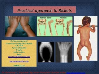Dr.Sandeep C Agrawal Agrasen Hospital Gondia India www.agrasenortho.com
Dr.Sandeep Agrawal
Consultant Orthopedic Surgeon
MS,DNB
Agrasen Hospital
Gondia
Maharashtra
India
drsandeep123@gmail.com
!
www.agrasenortho.com
!
09960122234
Practical approach to Rickets
 