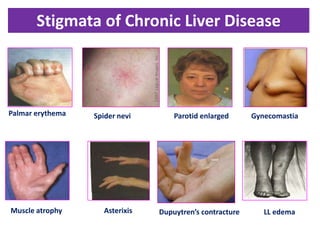 Stigmata of Chronic Liver Disease

Palmar erythema

Muscle atrophy

Spider nevi

Asterixis

Parotid enlarged

Dupuytren’s contracture

Gynecomastia

LL edema

 