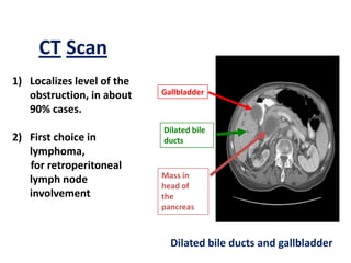 CT Scan
1) Localizes level of the
obstruction, in about
90% cases.
2) First choice in
lymphoma,
for retroperitoneal
lymph node
involvement

Gallbladder

Dilated bile
ducts

Mass in
head of
the
pancreas

Dilated bile ducts and gallbladder

 
