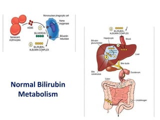 Normal Bilirubin
Metabolism

 