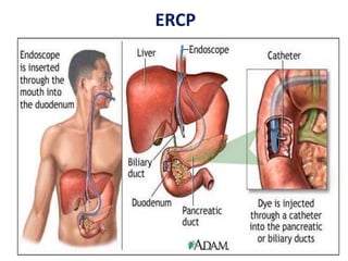 ERCP

 