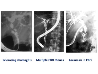 Sclerosing cholangitis

Multiple CBD Stones

Ascariasis in CBD

 