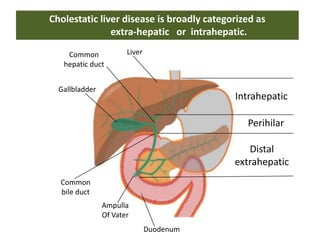 Cholestatic liver disease is broadly categorized as
extra-hepatic or intrahepatic.
Common
hepatic duct

Liver

Gallbladder

Intrahepatic
Perihilar
Distal
extrahepatic

Common
bile duct
Ampulla
Of Vater
Duodenum

 