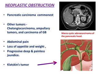 NEOPLASTIC OBSTRUCTION
• Pancreatic carcinoma commonest

• Other tumors Cholangiocarcinoma, ampullary
tumors, and carcinoma of GB
• Abdominal pain
• Loss of appetite and weight ,
• Progressive deep & painless
jaundice.
• Klatskin’s tumor

Macro cystic adenocarcinoma of
the pancreatic head.

 