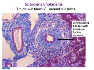 Sclerosing Cholangitis:
“Onion-skin fibrosis” around bile ducts

very thickened
bile duct wall
decreases
luminal
diameter

 