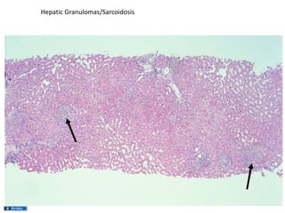 Hepatic Granulomas/Sarcoidosis

 