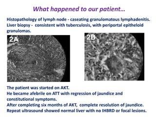 What happened to our patient…
Histopathology of lymph node - caseating granulomatous lymphadenitis.
Liver biopsy - consistent with tuberculosis, with periportal epitheloid
granulomas.

The patient was started on AKT.
He became afebrile on ATT with regression of jaundice and
constitutional symptoms.
After completing six months of AKT, complete resolution of jaundice.
Repeat ultrasound showed normal liver with no IHBRD or focal lesions.

 