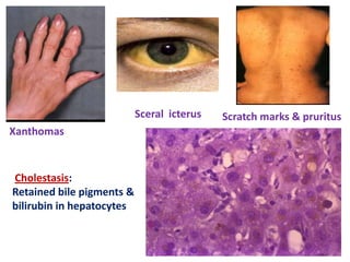 Sceral icterus
Xanthomas

Cholestasis:
Retained bile pigments &
bilirubin in hepatocytes

Scratch marks & pruritus

 