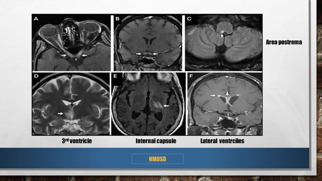 'Approach to cns demyelinating disorders | PDF | Physical Therapy ...