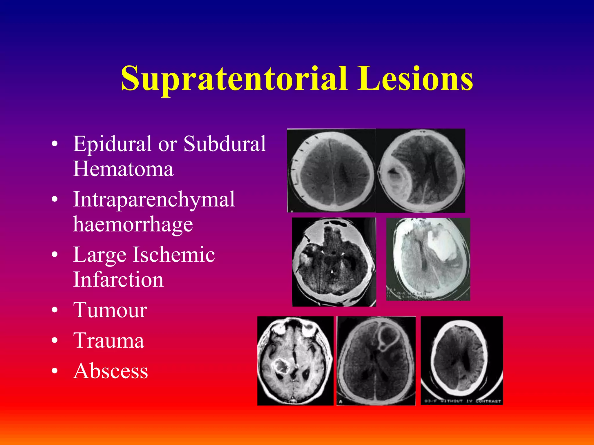 Supratentorial LesionsEpidural or Subdural Hematoma Intraparenchymal haemorrhageLarge Ischemic InfarctionTumourTraumaAbscess 