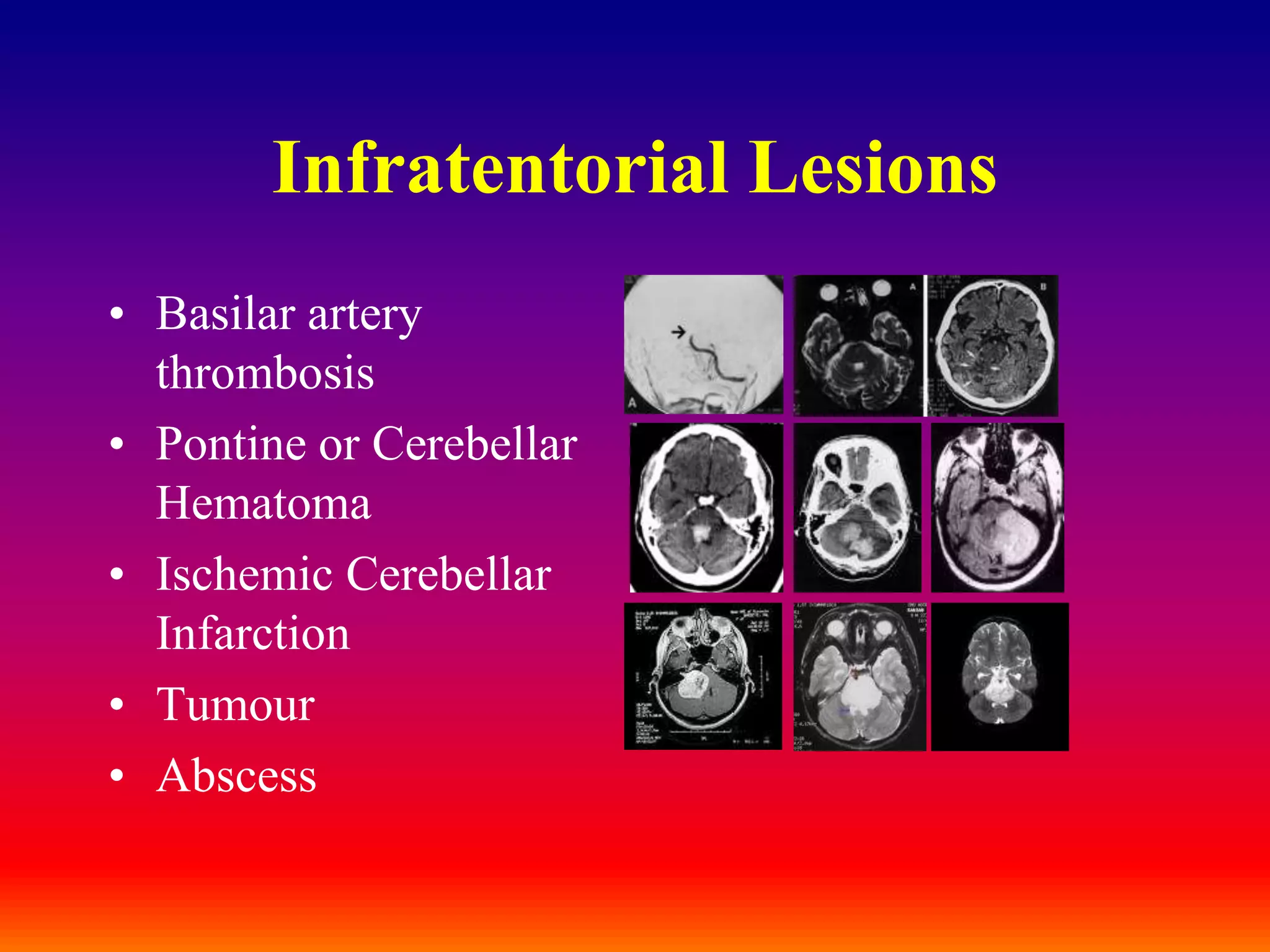 Infratentorial LesionsBasilar artery thrombosisPontine or Cerebellar HematomaIschemic Cerebellar InfarctionTumourAbscess