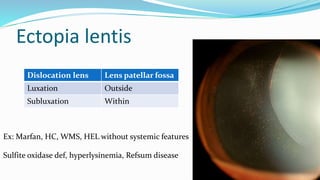 Sublux Ex An approach to congenital cataract genetic based | PPTX