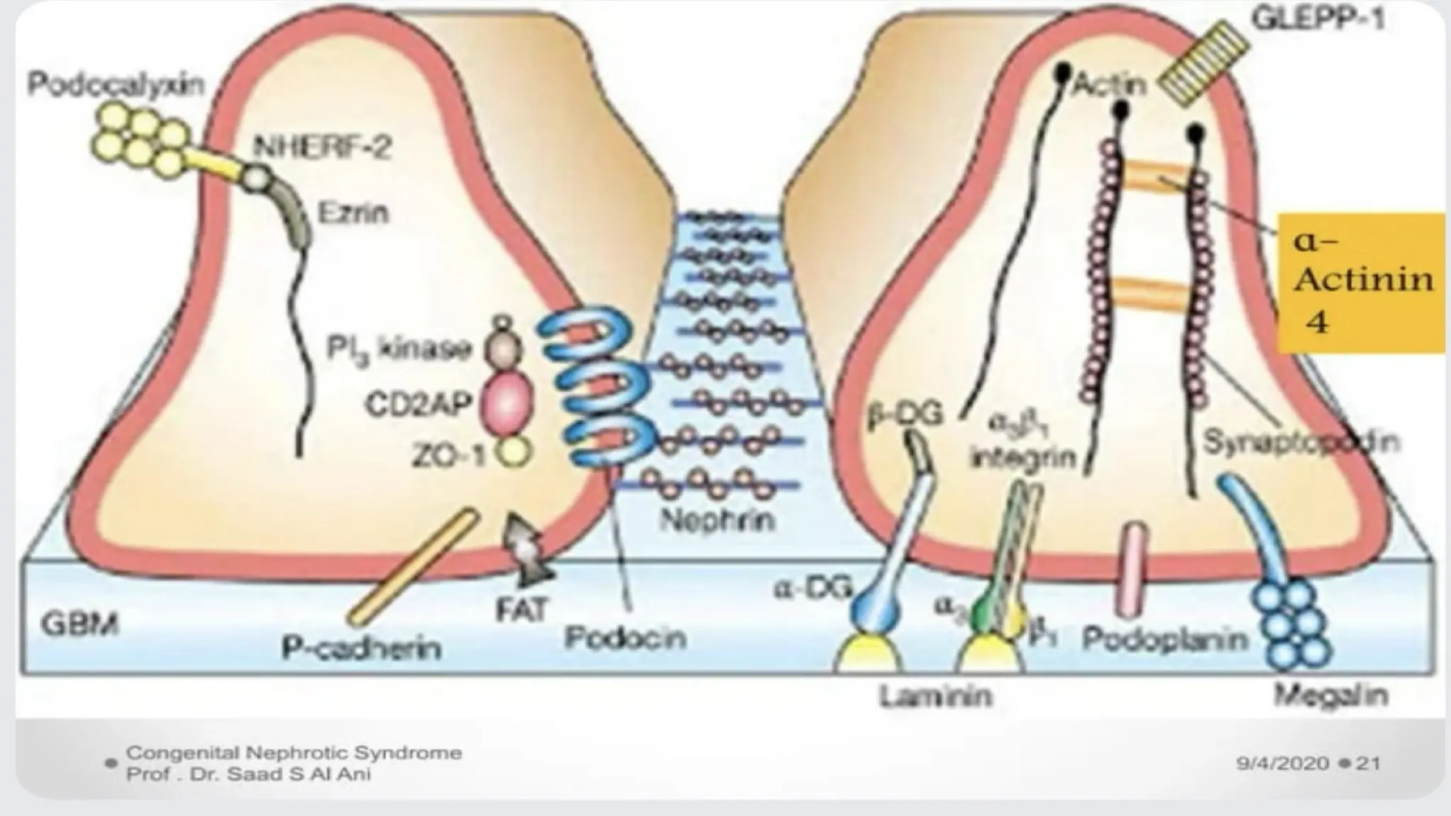 Approach to congenital nephrotic syndrome in child Samreena abid G18.pptx