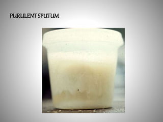 PURULENT SPUTUM
 