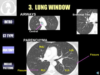 3. LUNG WINDOW
            AIRWAYS                        Bronchial Tree


 INTRO
                     Central

CT TYPE
               PARENCHYMA
                               RUL
ANATOMY                                LUL
                                                        Fissure


 DISEASE
PATTERNS
           Fissure             RLL   LLL
 