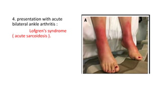 4. presentation with acute
bilateral ankle arthritis :
Lofgren's syndrome
( acute sarcoidosis ).
 