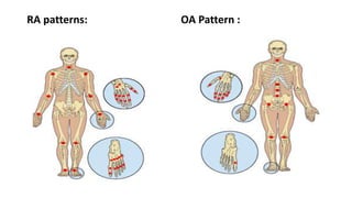 RA patterns: OA Pattern :
 