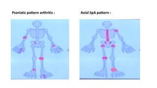 Psoriatic pattern arthritis : Axial SpA pattern :
 