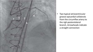 • Two typical atrioventricular
groove epicardial collaterals
from the circumflex artery to
the righ posterolateral
branch. Arrowheads indicate
a straight connection
 