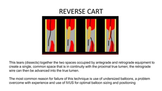 REVERSE CART
This tears (dissects) together the two spaces occupied by antegrade and retrograde equipment to
create a single, common space that is in continuity with the proximal true lumen; the retrograde
wire can then be advanced into the true lumen.
The most common reason for failure of this technique is use of undersized balloons, a problem
overcome with experience and use of IVUS for optimal balloon sizing and positioning
 
