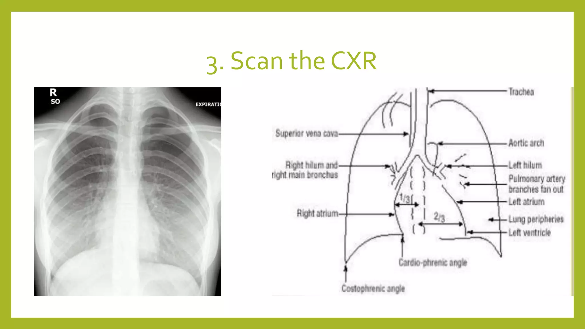 3. Scan the CXR
 