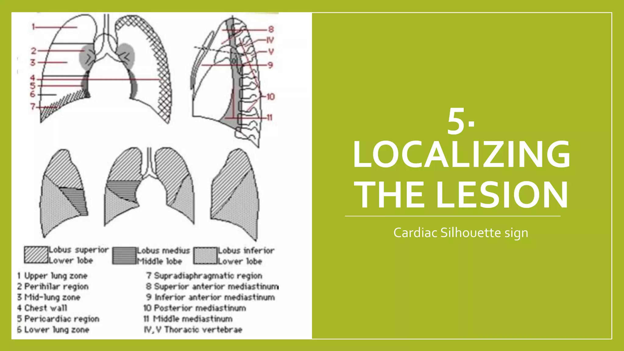 5.
LOCALIZING
THE LESION
Cardiac Silhouette sign
 