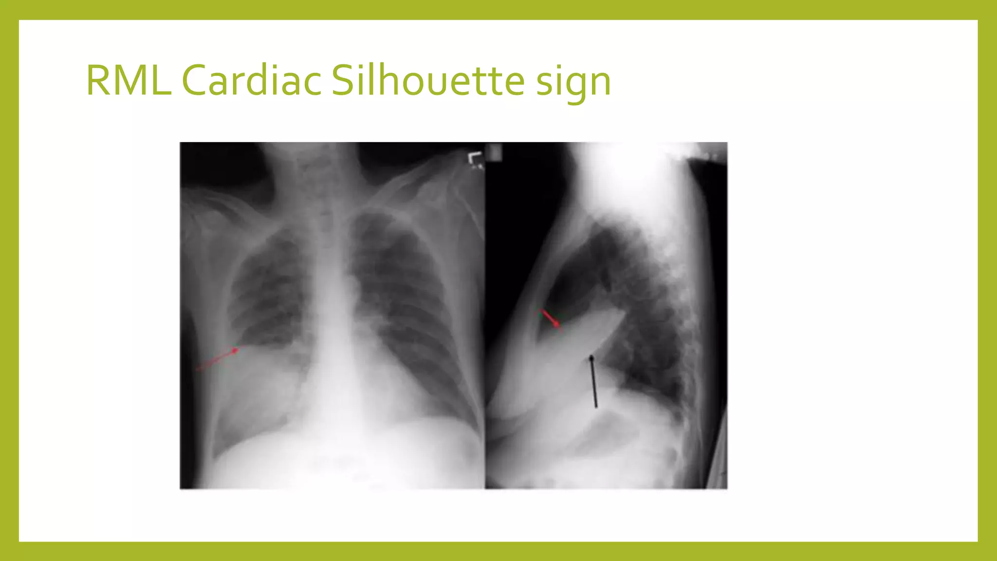 RML Cardiac Silhouette sign
 