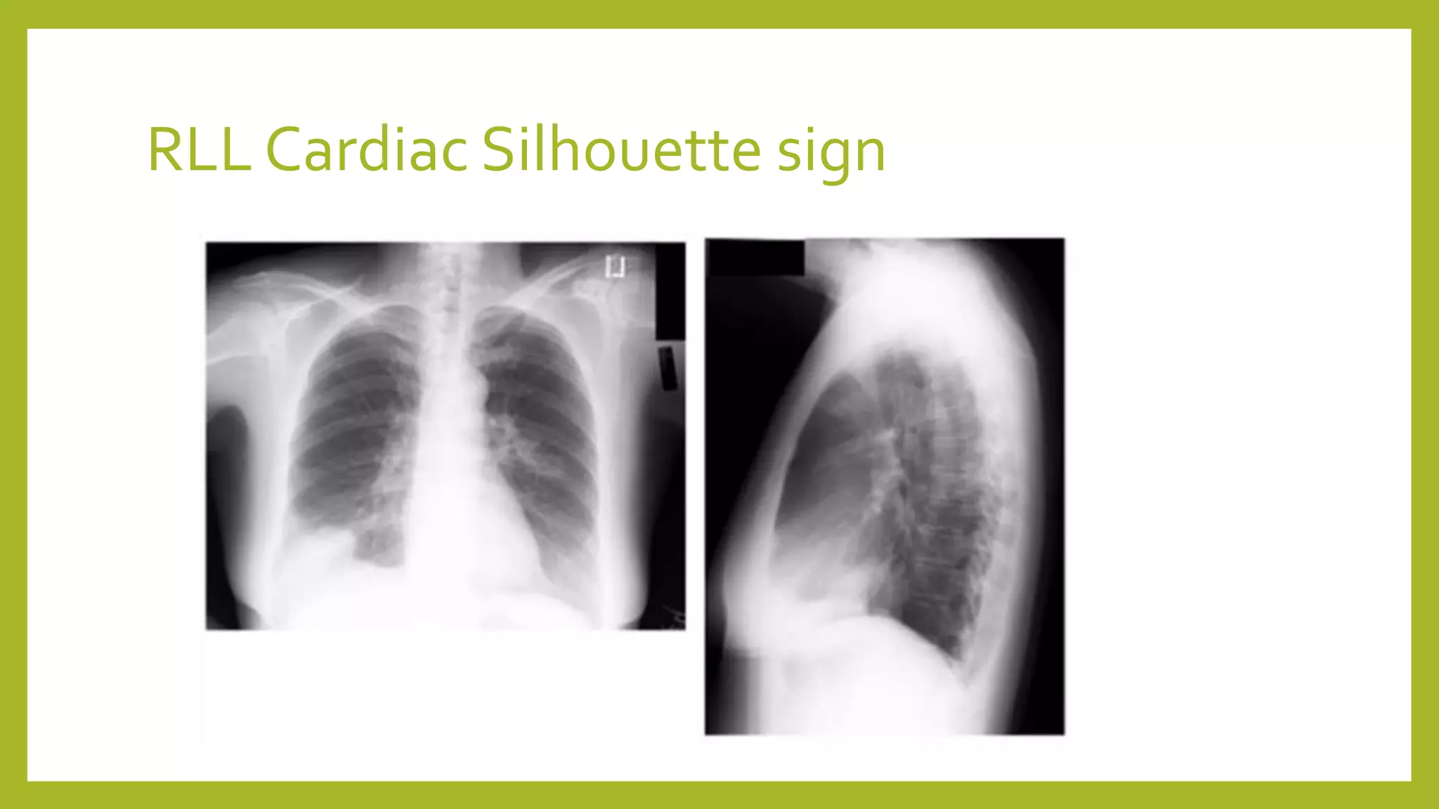 RLL Cardiac Silhouette sign
 
