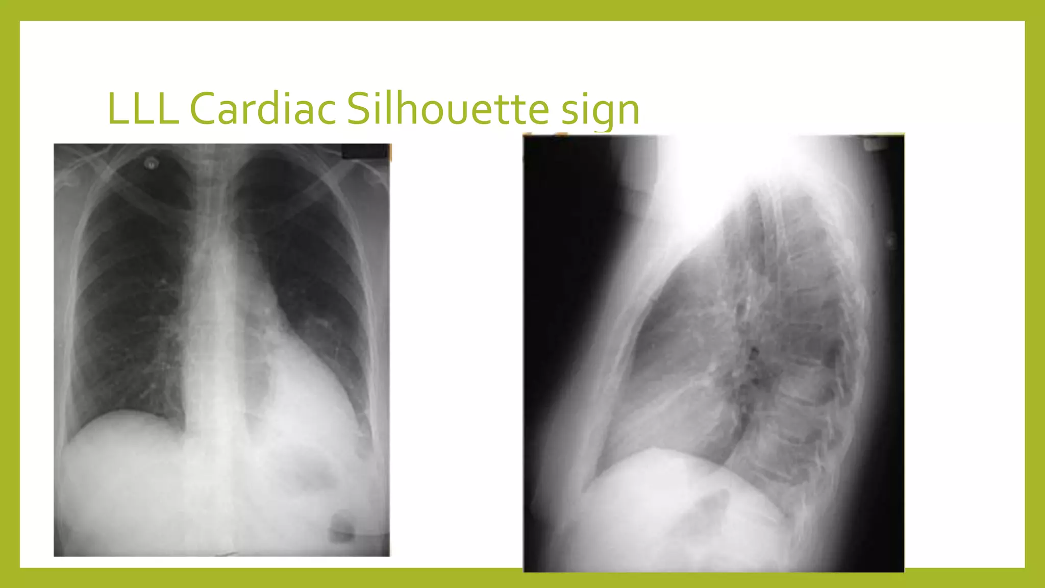 LLL Cardiac Silhouette sign
 