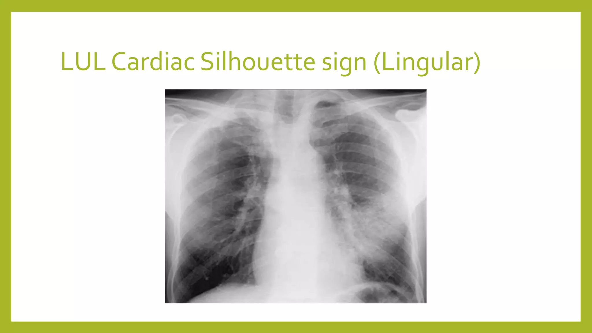 LUL Cardiac Silhouette sign (Lingular)
 