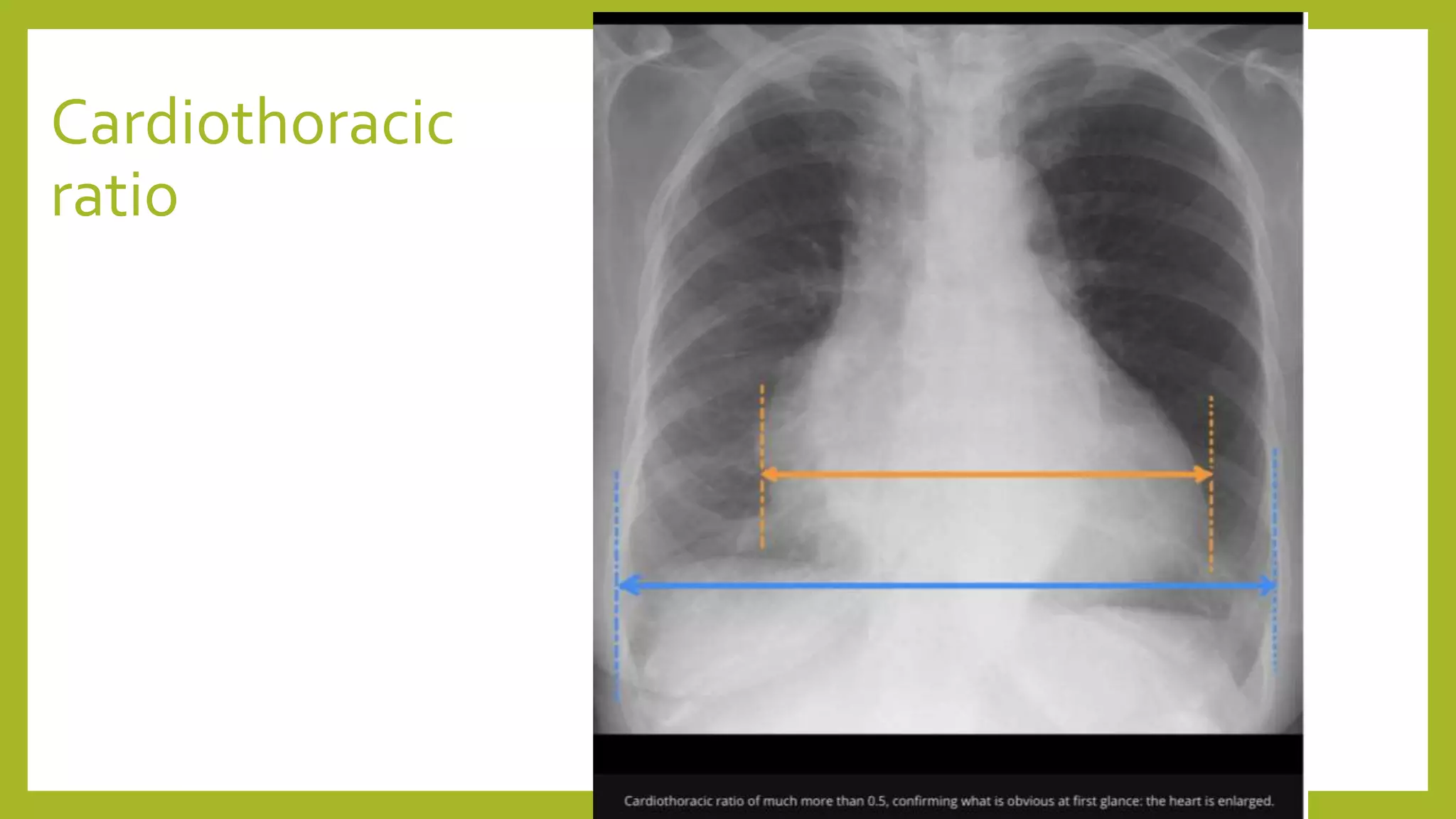 Cardiothoracic
ratio
 
