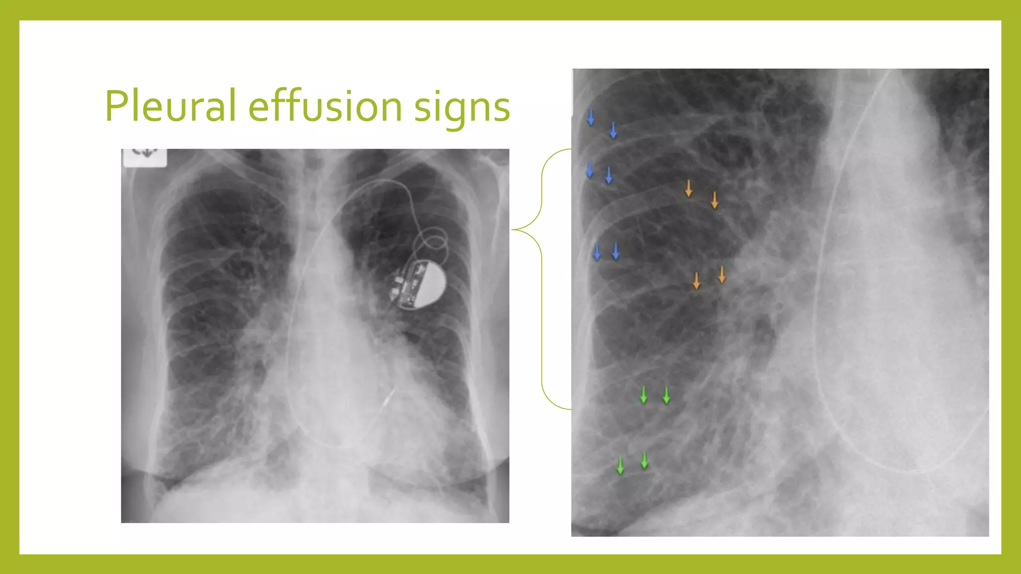 Pleural effusion signs
 