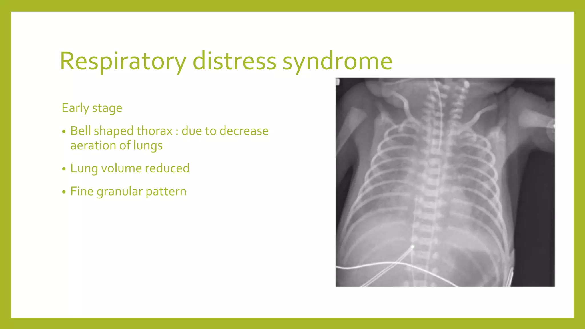 Respiratory distress syndrome
Early stage
• Bell shaped thorax : due to decrease
aeration of lungs
• Lung volume reduced
• Fine granular pattern
 