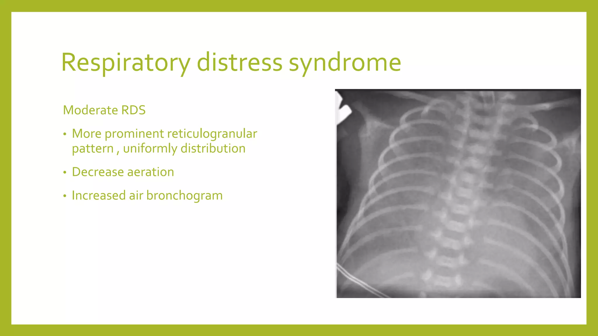 Respiratory distress syndrome
Moderate RDS
• More prominent reticulogranular
pattern , uniformly distribution
• Decrease aeration
• Increased air bronchogram
 